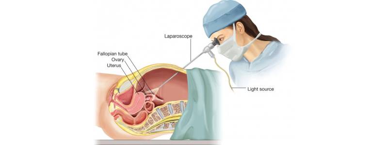 Diagnostic Laparoscopy Surgery in Goregaon