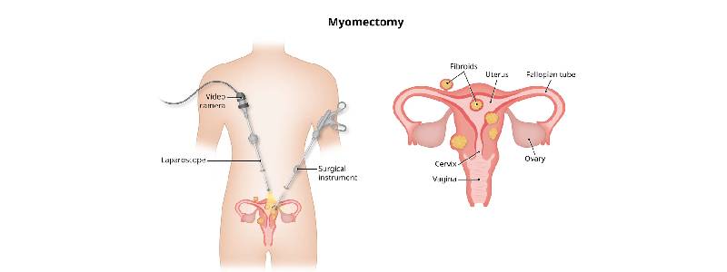 Uterine Fibroid Removal Surgery in Goregaon